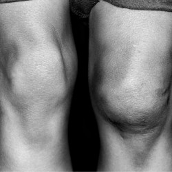 Knee-dislocation-sydney